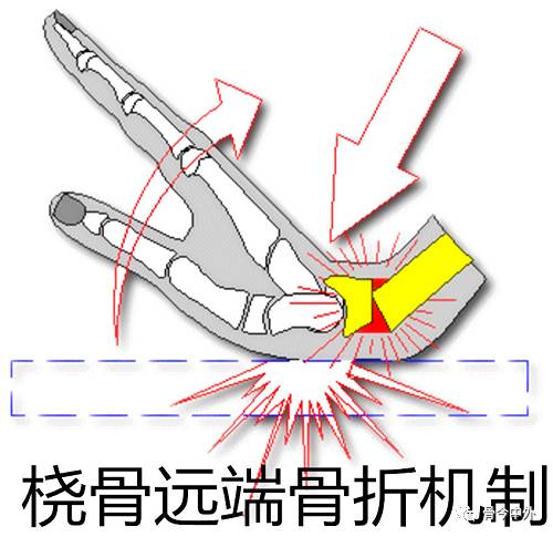 骨科基础桡骨远端骨折分型与掌侧入路