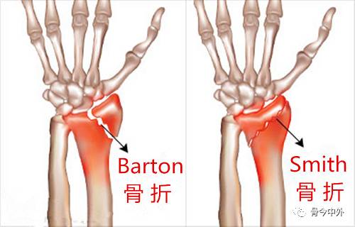 骨科基础桡骨远端骨折分型与掌侧入路