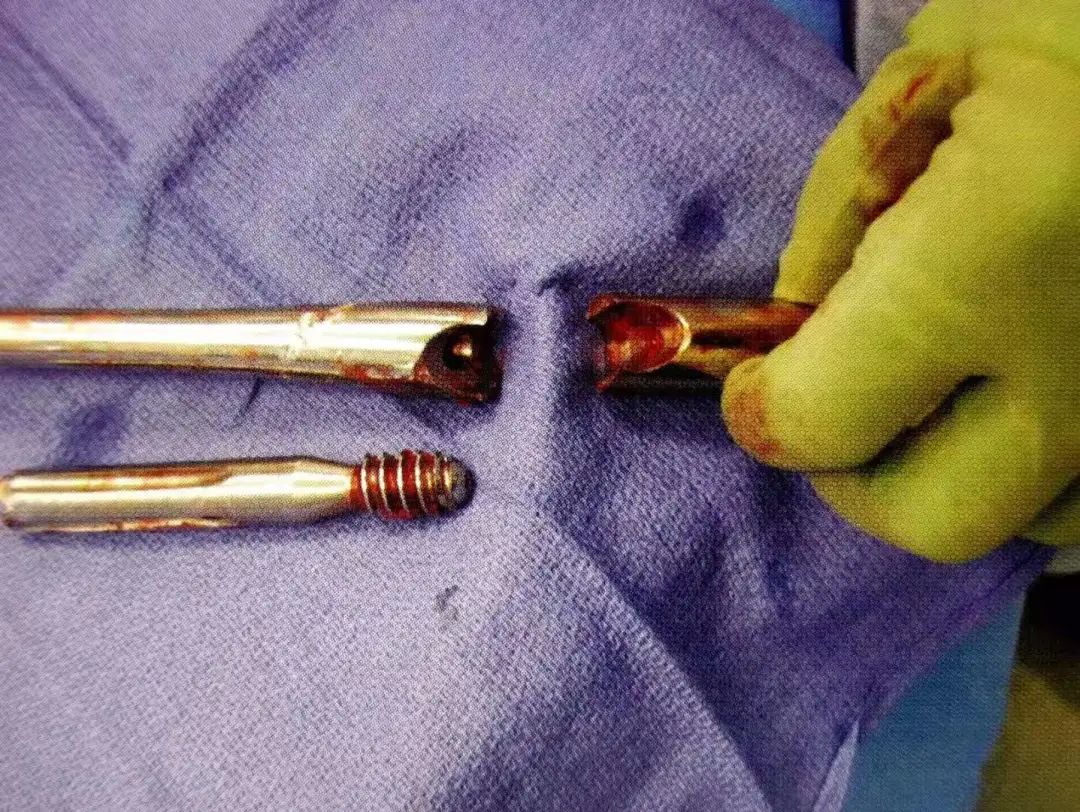 『8分钟创伤』股骨转子下骨折的髓内钉治疗,手术要点看这里!