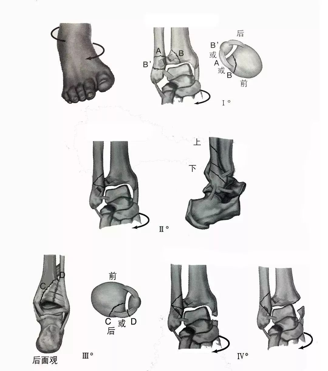 踝关节骨折分型图片图片