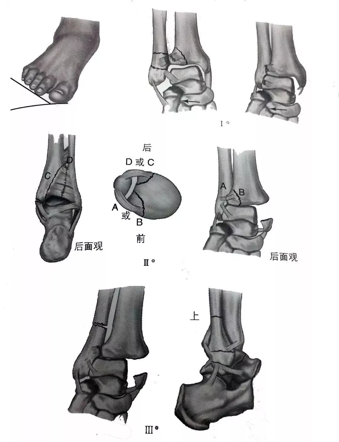 详解踝关节lauge-hansen分型 - 上海开为医药科技有限公司--创伤,肢体
