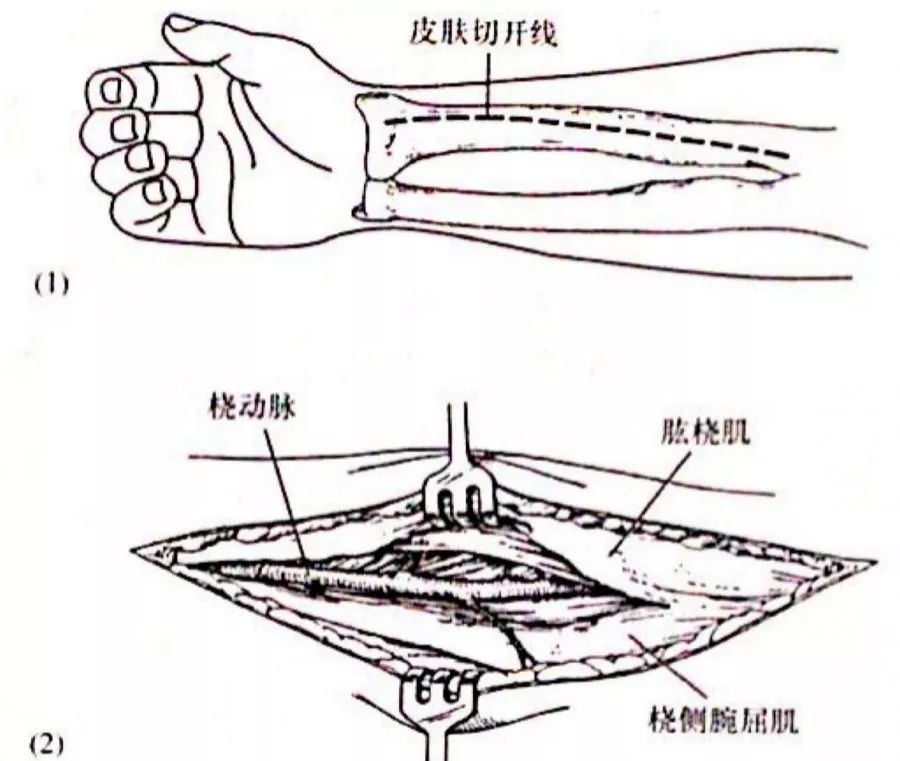 桡骨远端骨折治疗策略与手术入路