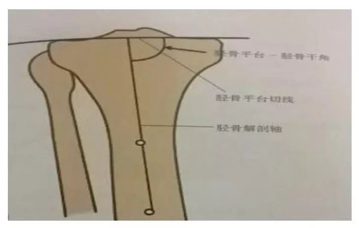 肘关节外翻测量图示图片