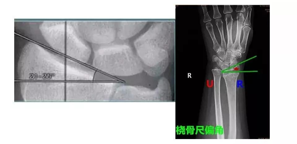 桡骨尺偏角桡骨掌倾角是指在腕关节侧位片中,桡骨远端关节面掌,背侧最