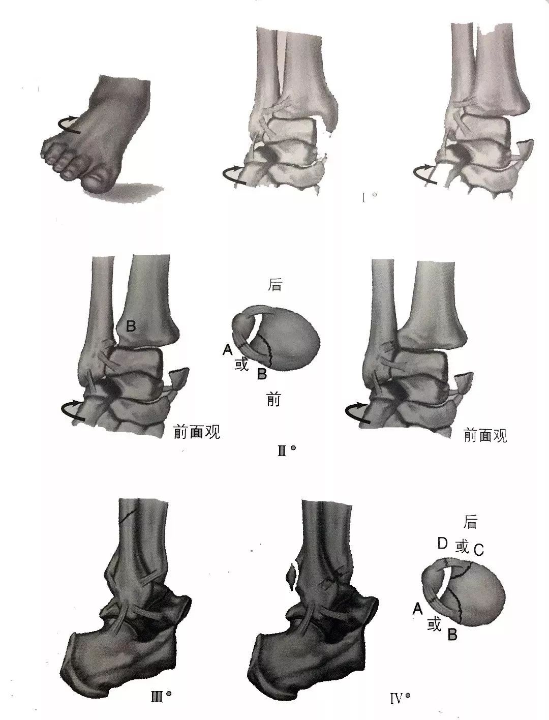 详解踝关节lauge-hansen分型 - 上海开为医药科技有限公司--创伤,肢体