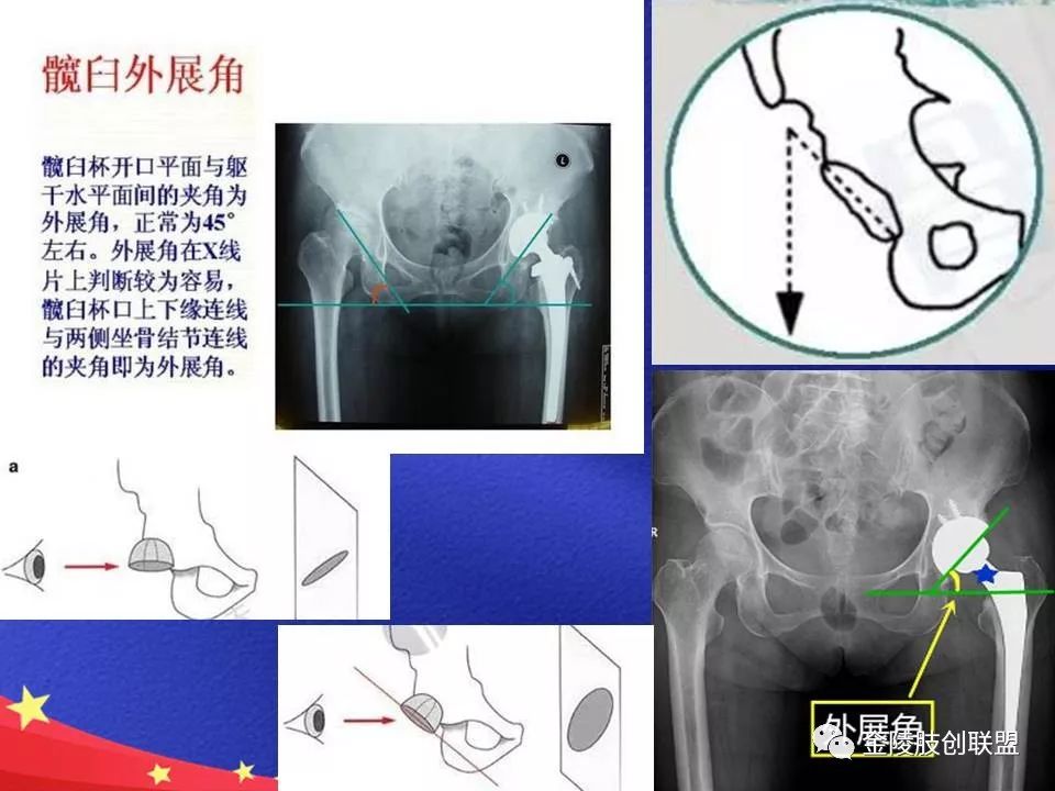 髋臼角和髂骨角:髋臼角也叫髋臼指数(al),髂骨最下缘与髋臼外缘的连线