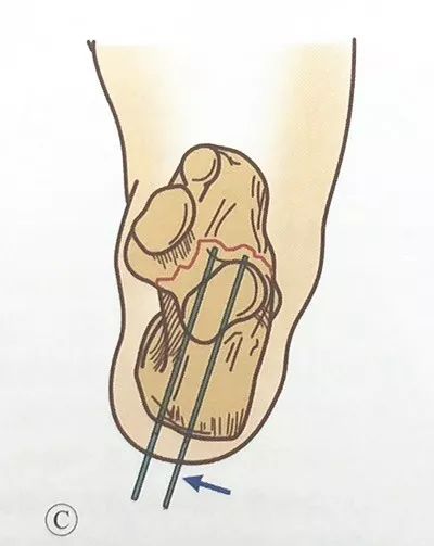 跟骨结节撕脱骨折的复位和固定:跟骨结节撕脱骨折的手术指征包括开放