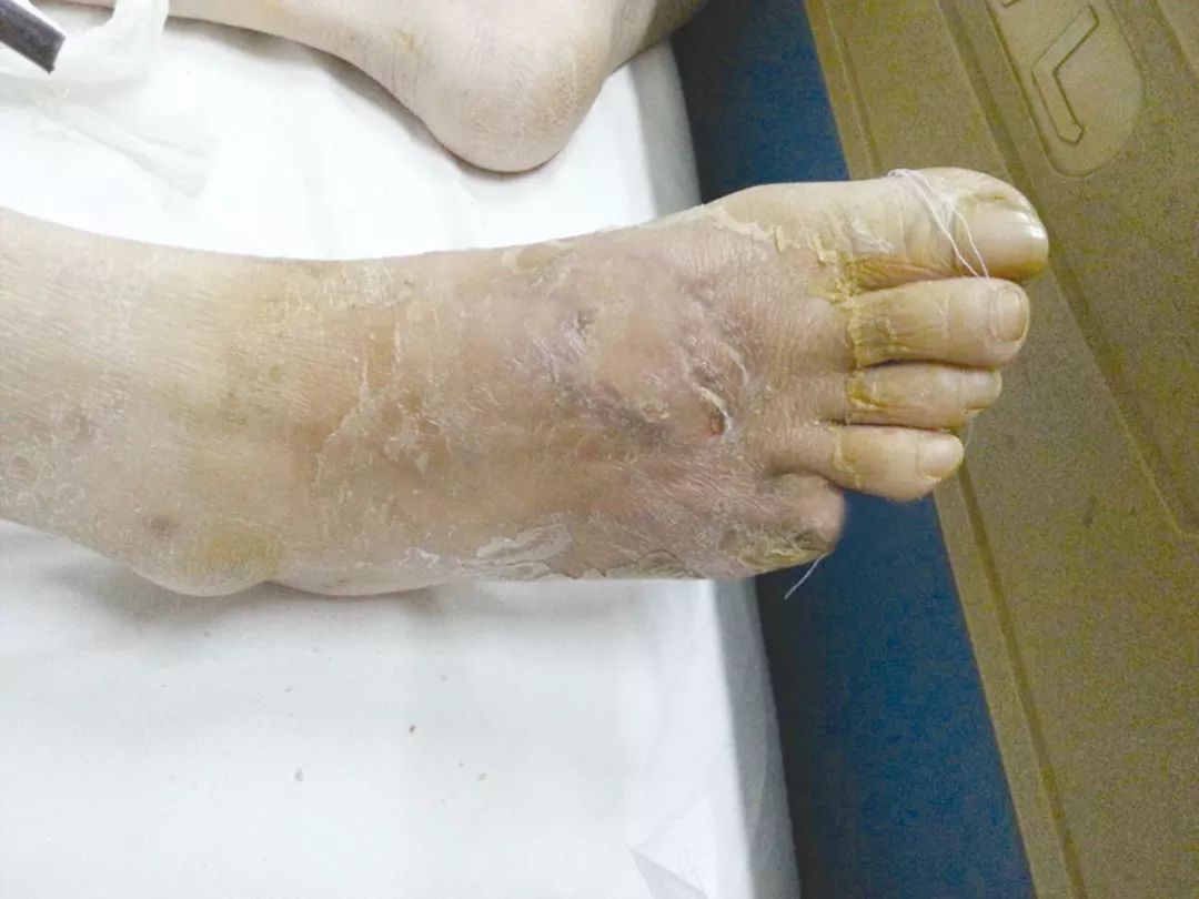 横向骨搬移支架在下肢缺血性疾病中的应用 - 上海开为医药科技有限