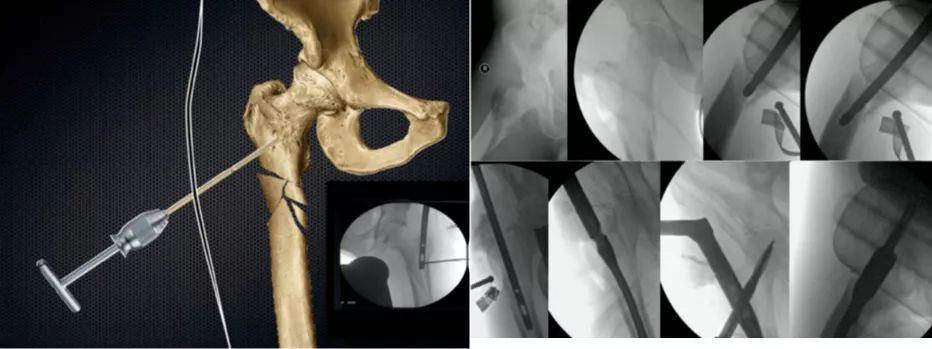 青壮年股骨转子下骨折的髓内钉复位与进针要点 - 上海开为医药科技