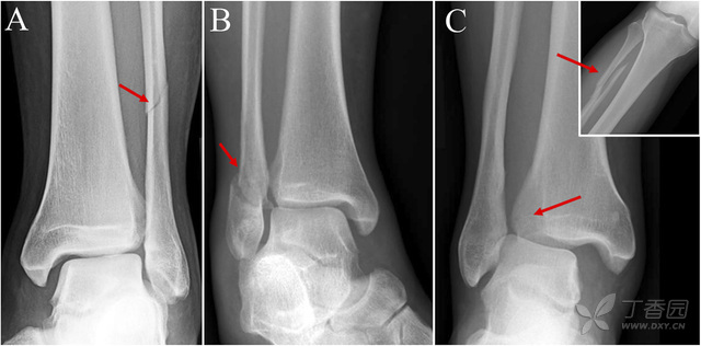 jbjs概念回顾:踝关节下胫腓联合韧带损伤