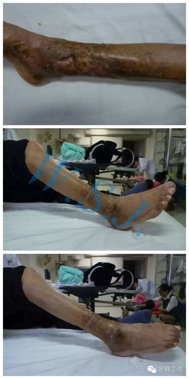 病例分享复杂开放性胫骨pilon骨折