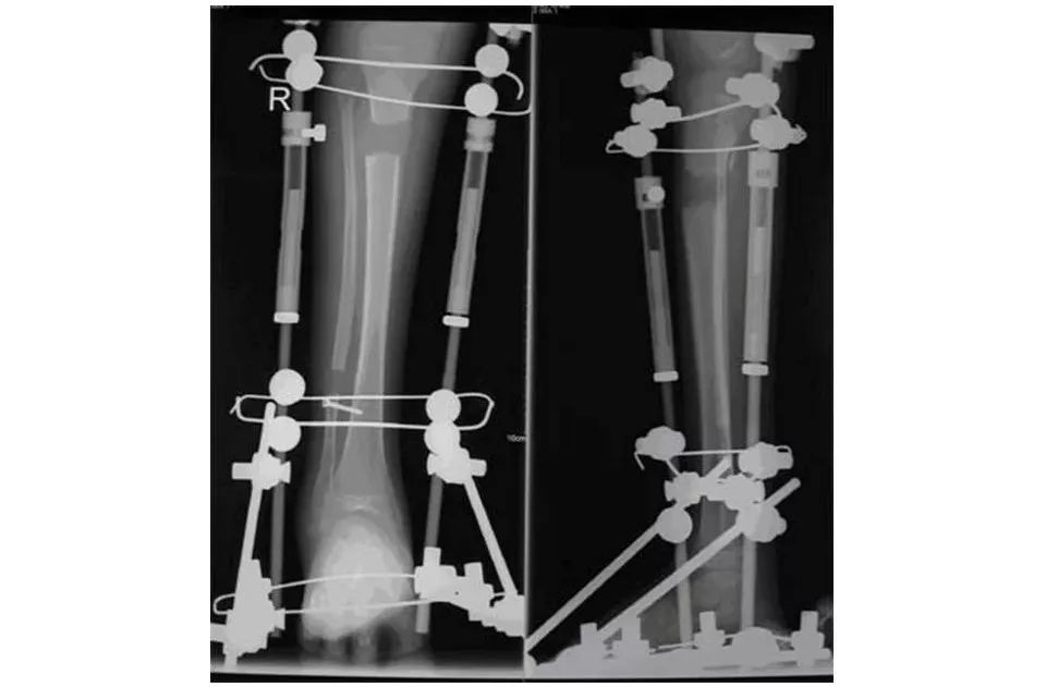 医用石膏夹板怎么用最全汇总 ｜ 4种骨科常用外固定_https://www.jmylbn.com_新闻资讯_第29张