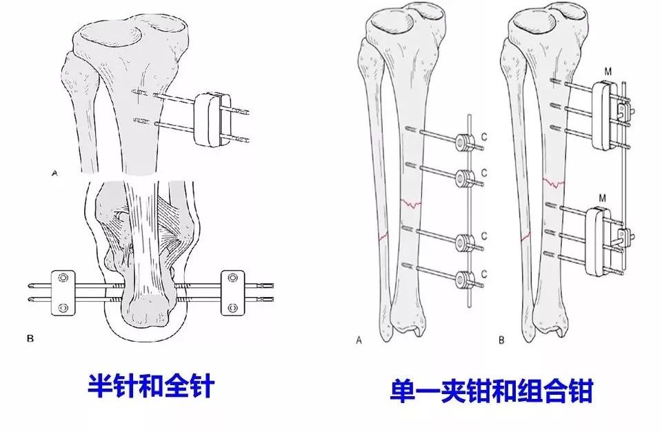 医用石膏夹板怎么用最全汇总 ｜ 4种骨科常用外固定_https://www.jmylbn.com_新闻资讯_第19张