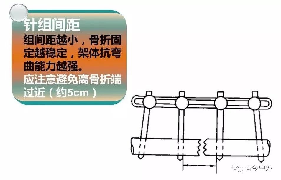 医用石膏夹板怎么用最全汇总 ｜ 4种骨科常用外固定_https://www.jmylbn.com_新闻资讯_第34张