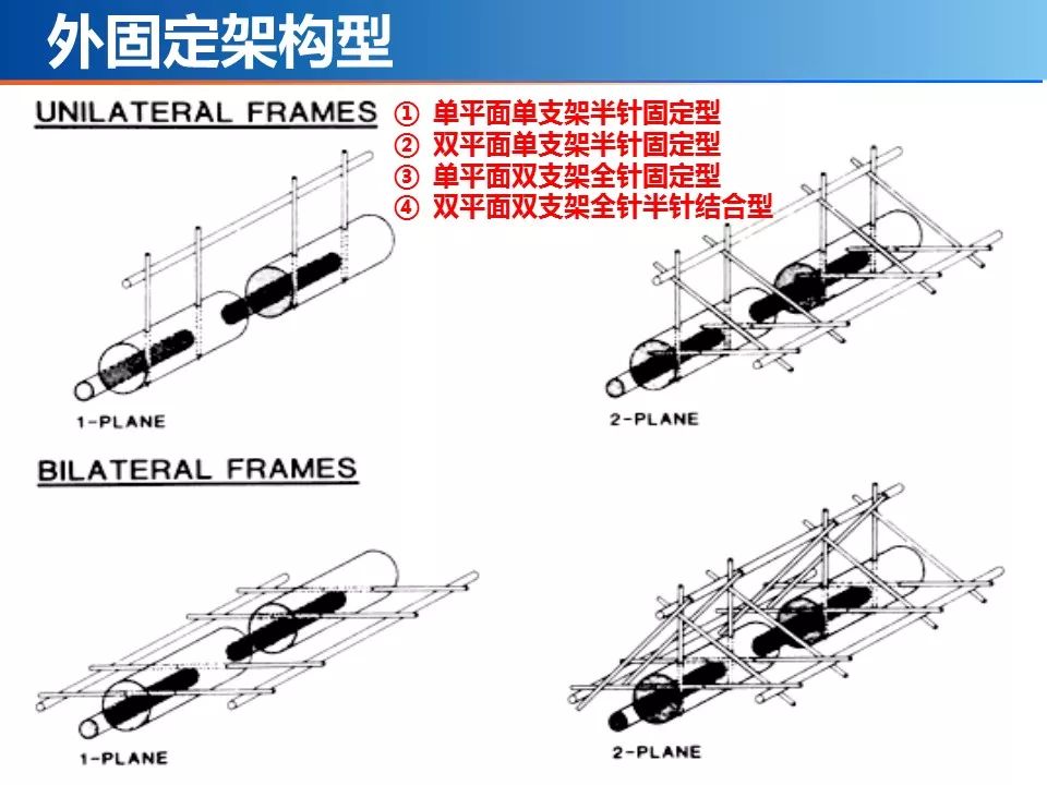医用石膏夹板怎么用最全汇总 ｜ 4种骨科常用外固定_https://www.jmylbn.com_新闻资讯_第20张