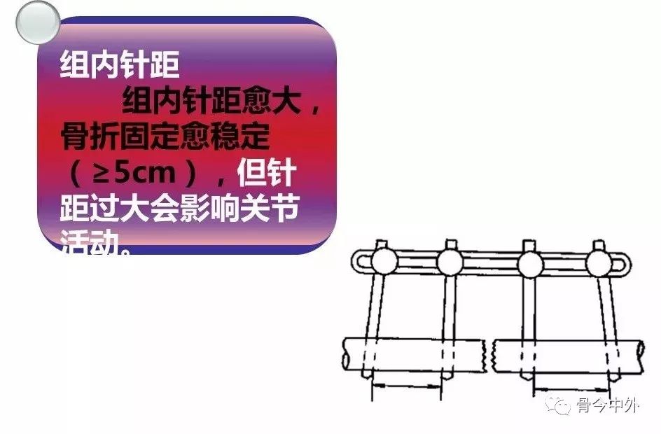 医用石膏夹板怎么用最全汇总 ｜ 4种骨科常用外固定_https://www.jmylbn.com_新闻资讯_第33张