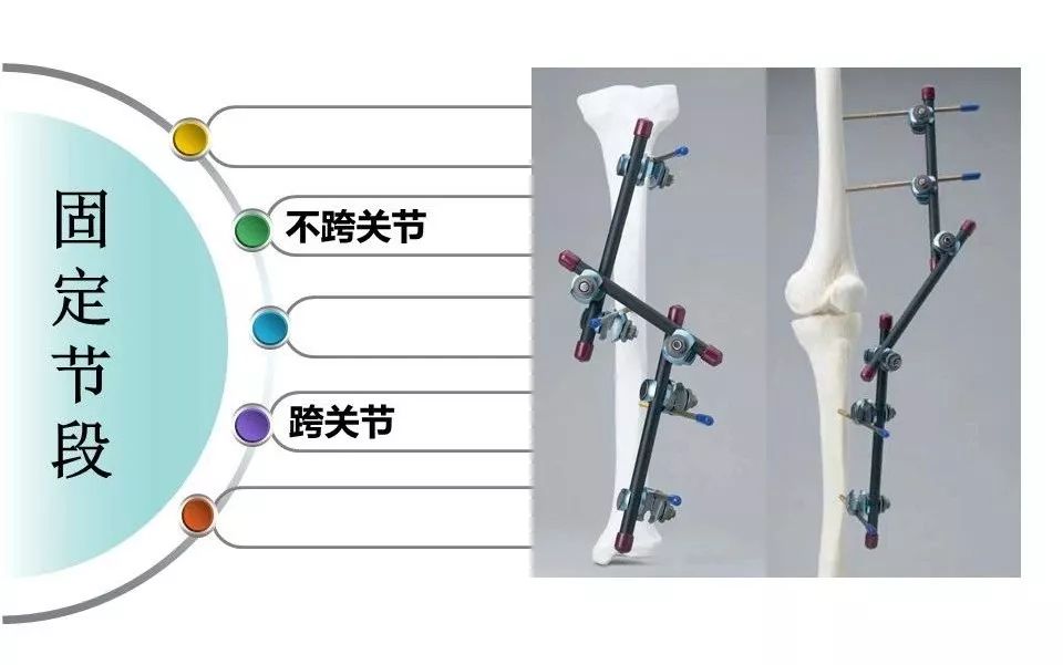 医用石膏夹板怎么用最全汇总 ｜ 4种骨科常用外固定_https://www.jmylbn.com_新闻资讯_第32张