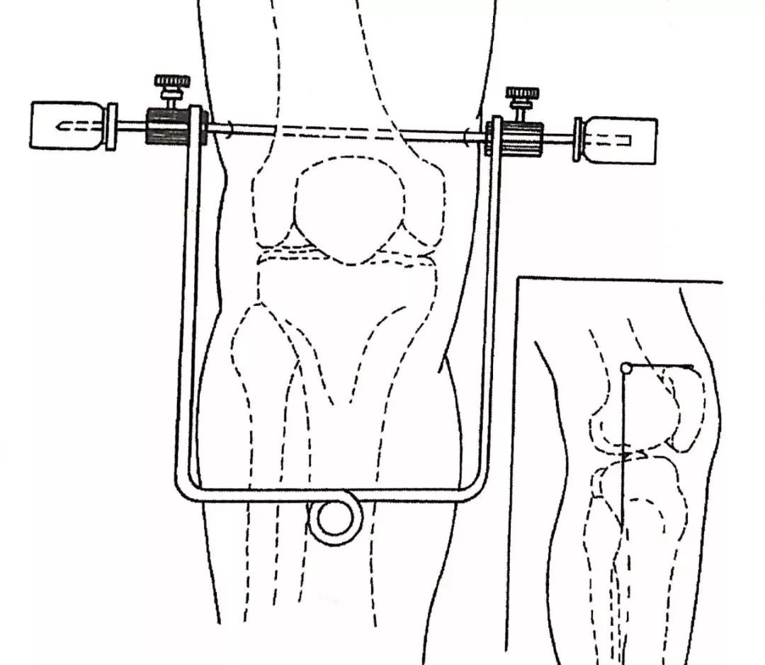 医用石膏夹板怎么用最全汇总 ｜ 4种骨科常用外固定_https://www.jmylbn.com_新闻资讯_第17张