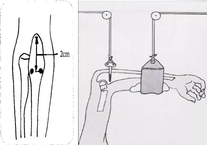 医用石膏夹板怎么用最全汇总 ｜ 4种骨科常用外固定_https://www.jmylbn.com_新闻资讯_第15张