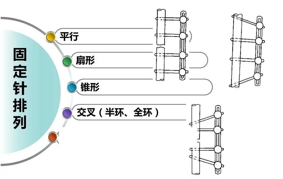 医用石膏夹板怎么用最全汇总 ｜ 4种骨科常用外固定_https://www.jmylbn.com_新闻资讯_第31张