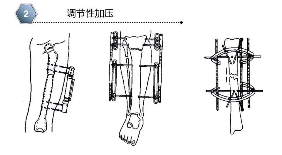 医用石膏夹板怎么用最全汇总 ｜ 4种骨科常用外固定_https://www.jmylbn.com_新闻资讯_第25张