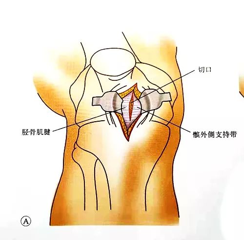 股骨系列——逆行髓内钉置入技巧