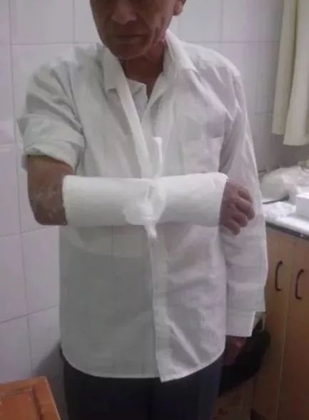 医用石膏夹板怎么用最全汇总 ｜ 4种骨科常用外固定_https://www.jmylbn.com_新闻资讯_第10张