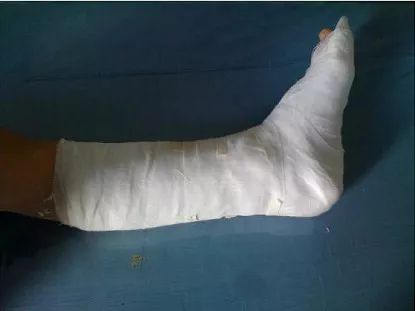 医用石膏夹板怎么用最全汇总 ｜ 4种骨科常用外固定_https://www.jmylbn.com_新闻资讯_第6张