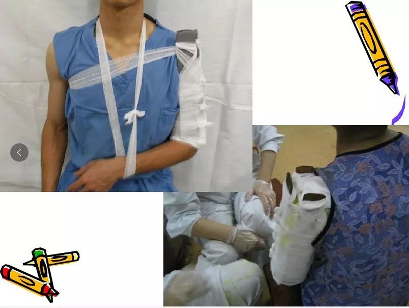 医用石膏夹板怎么用最全汇总 ｜ 4种骨科常用外固定_https://www.jmylbn.com_新闻资讯_第2张