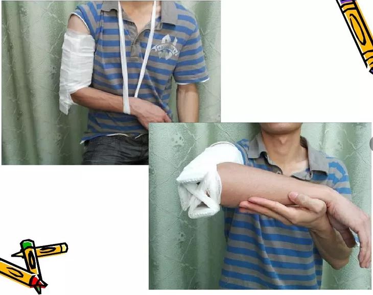 医用石膏夹板怎么用最全汇总 ｜ 4种骨科常用外固定_https://www.jmylbn.com_新闻资讯_第3张