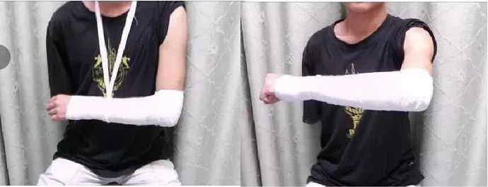 医用石膏夹板怎么用最全汇总 ｜ 4种骨科常用外固定_https://www.jmylbn.com_新闻资讯_第9张