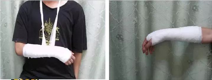 医用石膏夹板怎么用最全汇总 ｜ 4种骨科常用外固定_https://www.jmylbn.com_新闻资讯_第8张