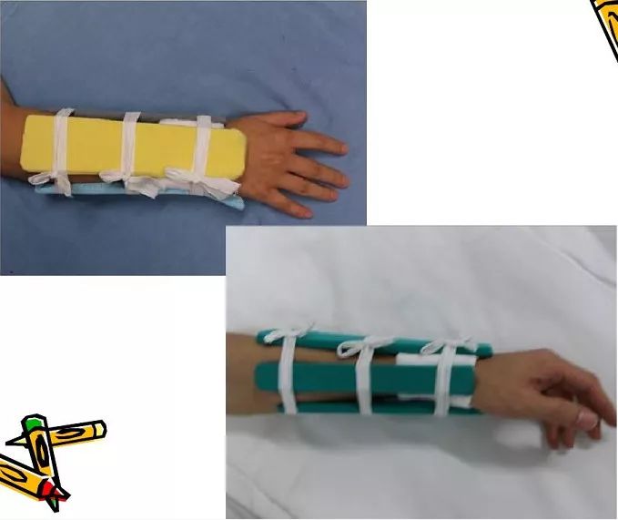 医用石膏夹板怎么用最全汇总 ｜ 4种骨科常用外固定_https://www.jmylbn.com_新闻资讯_第4张