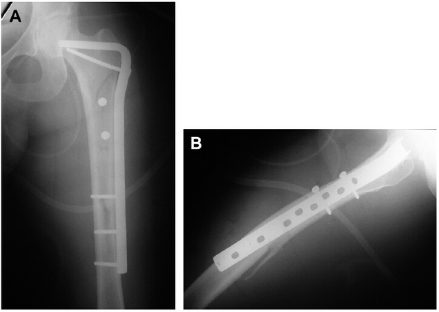 95°动力髋螺钉和角度固定钢板是早期治疗股骨转子下骨折的合适方法