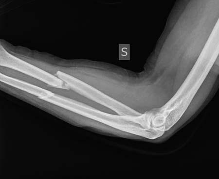 有图有真相系列:髓内钉治疗前臂骨干骨折 - 丁香园 - 上海开为医药