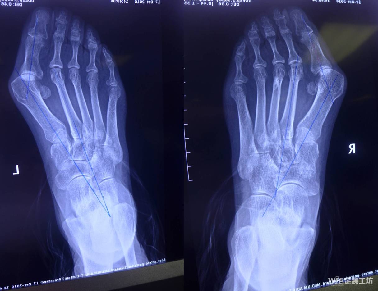 akin截骨术在拇外翻手术中的应用学组专辑