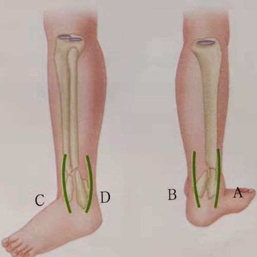 什么是外固定架『8分钟创伤』＊＊环形外固定架治疗胫骨 Pilon骨折_https://www.jmylbn.com_新闻资讯_第2张
