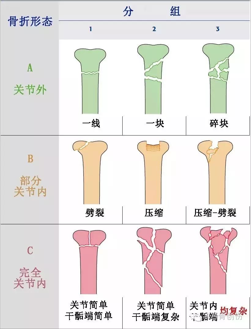 什么是外固定架『8分钟创伤』＊＊环形外固定架治疗胫骨 Pilon骨折_https://www.jmylbn.com_新闻资讯_第6张