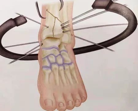 什么是外固定架『8分钟创伤』＊＊环形外固定架治疗胫骨 Pilon骨折_https://www.jmylbn.com_新闻资讯_第4张