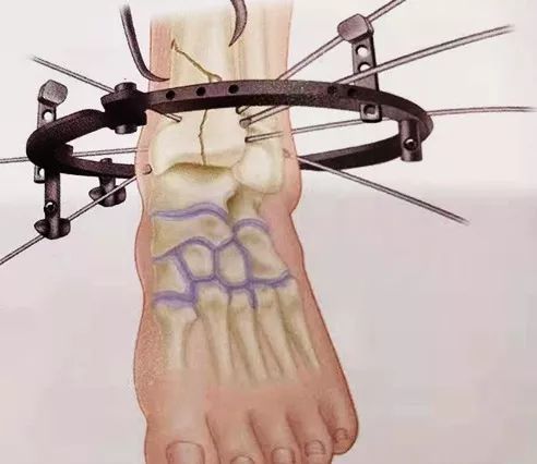 什么是外固定架『8分钟创伤』＊＊环形外固定架治疗胫骨 Pilon骨折_https://www.jmylbn.com_新闻资讯_第5张