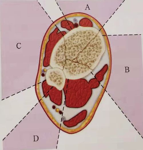 什么是外固定架『8分钟创伤』＊＊环形外固定架治疗胫骨 Pilon骨折_https://www.jmylbn.com_新闻资讯_第1张