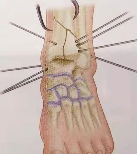 什么是外固定架『8分钟创伤』＊＊环形外固定架治疗胫骨 Pilon骨折_https://www.jmylbn.com_新闻资讯_第3张