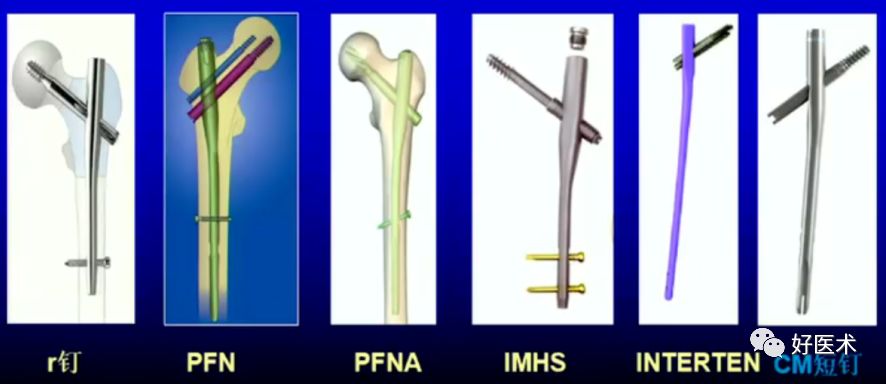 固定优先采用的方法种类众多:r钉(r2,r3),pfn,pfn一a,trigen intertan