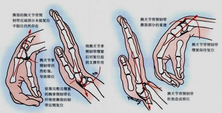 smith骨折固定于前臂旋后和腕关节背伸位colles骨折固定于掌屈5°～15