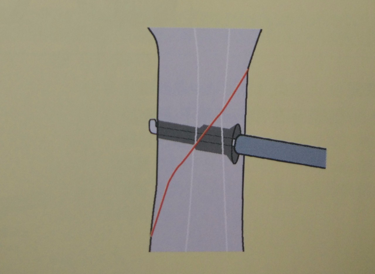 近节指骨螺旋形骨折:拉力螺钉 - 上海开为医药科技有限公司--创伤