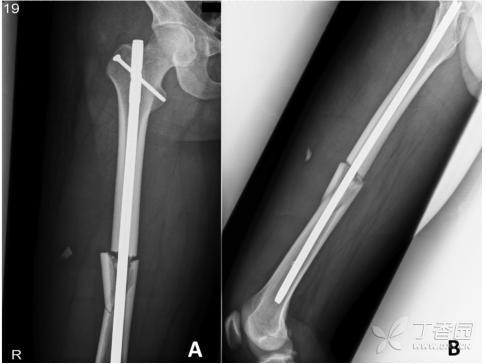 移位>1cm蝶形骨块:股骨干骨折闭合复位髓内钉也可能不愈合