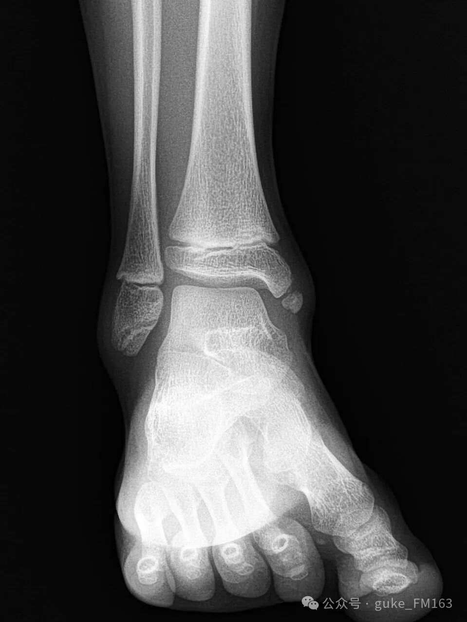 早读胫下骨容易误诊内踝骨折