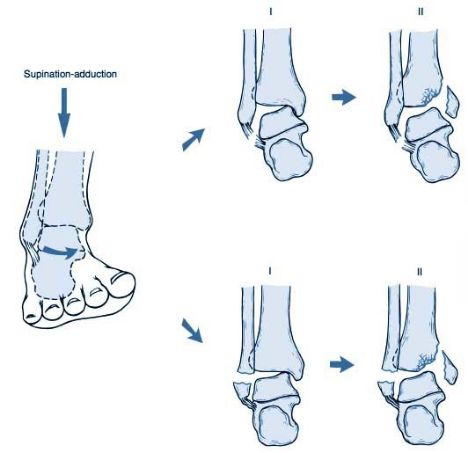 骨折特点(1)内踝骨折线基本垂直于踝关节(2)腓骨骨折位于下胫腓联合