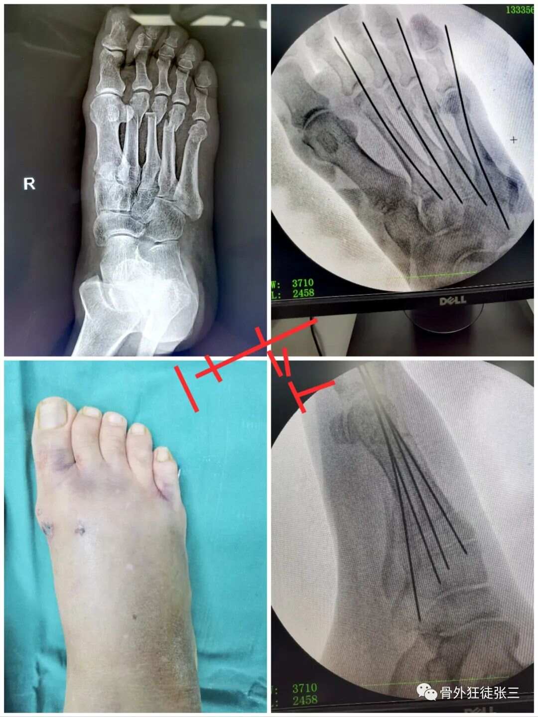 病例系列|“万能克氏针”之针人针事!(56例病例汇总) - 上海开为医药科技有限公司--创伤、肢体矫形技术解决方案的专业服务商