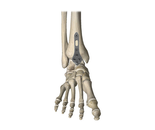 胫距前踝融合锁定板